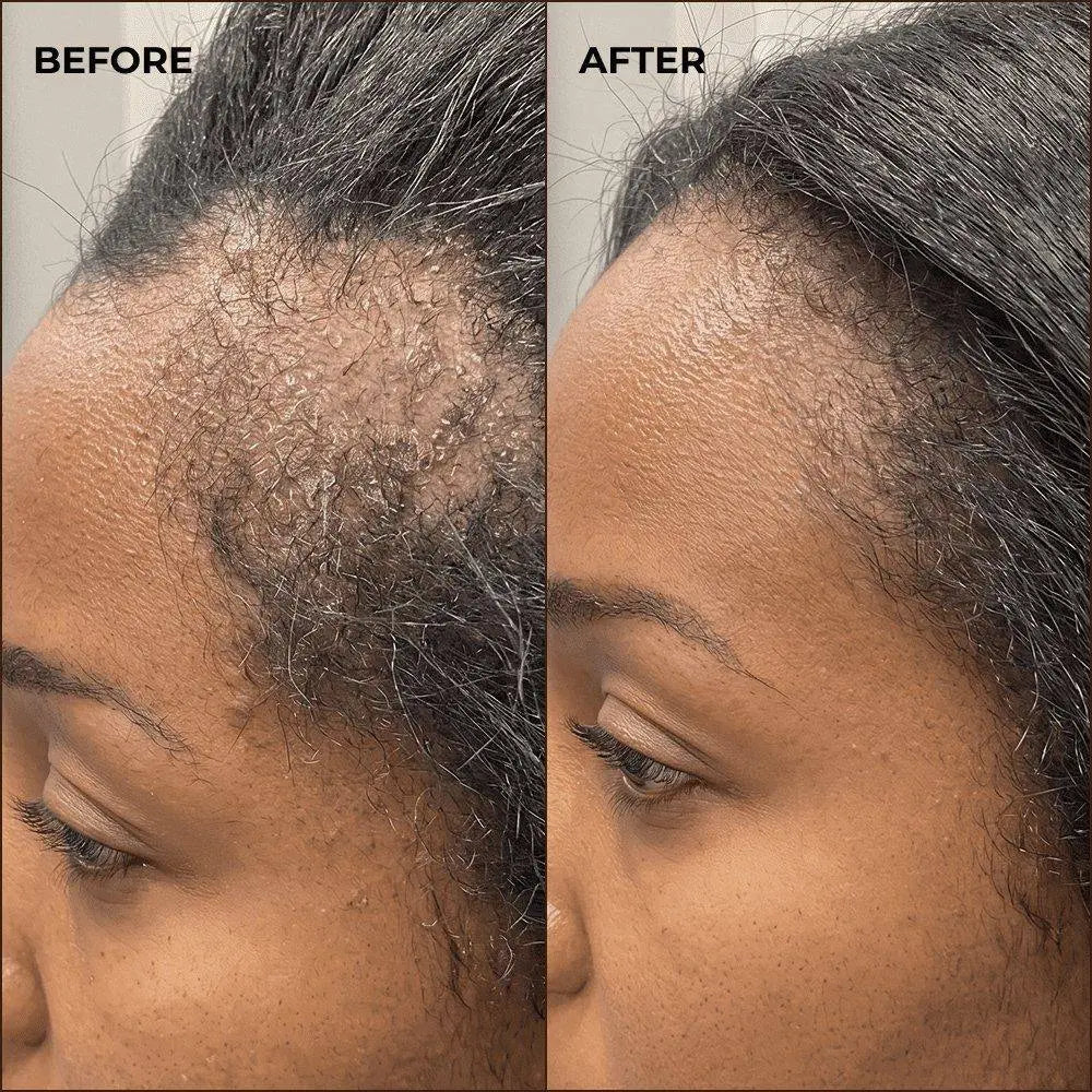 Before and after using Spoild Batana Oil